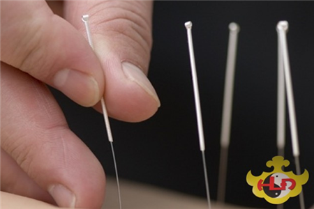 Phương pháp châm cứu