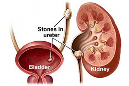 Bệnh sỏi thận