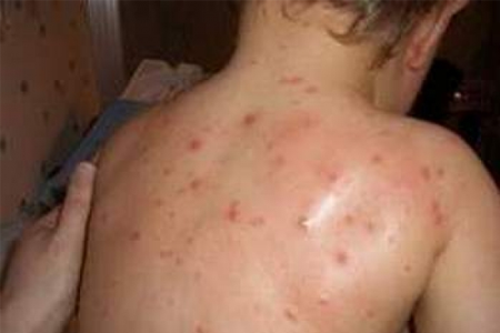 Bệnh thủy đậu