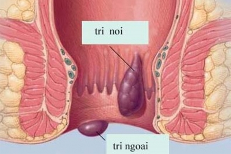 Bệnh trĩ