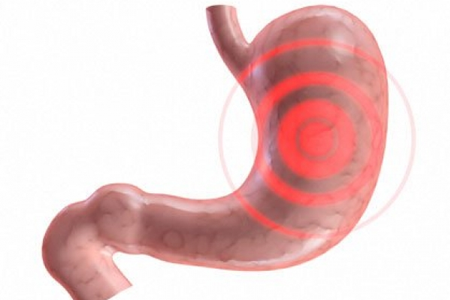 Bệnh viêm loát dạ dày